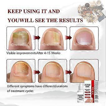 Nail Care Renewal for Thick, Damaged & Discolored Nails, Plant Based Formula for Healthy Nail and Skin - 0.5 Fl Oz