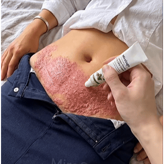 Advanced Psoriasis & Eczema Relief Cream
