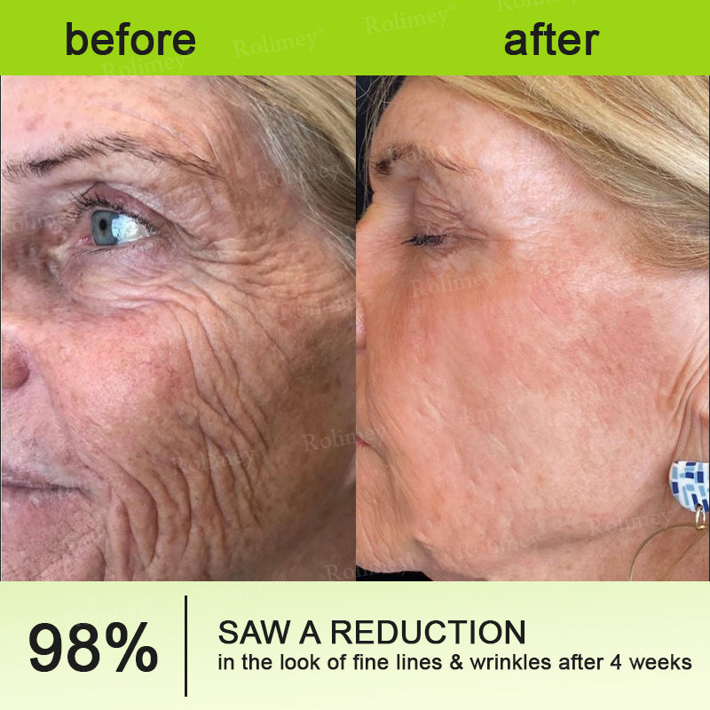 Final 3 Hours: 70%OFF🔥 QIAWI™ Botulinum & Vita-A Retinol Shot Wrinkle-Lift Tightening cream✨