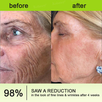 Final 3 Hours: 70%OFF🔥 QIAWI™ Botulinum & Vita-A Retinol Shot Wrinkle-Lift Tightening cream✨