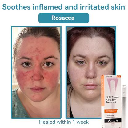 💞All-in-One CO₂ Laser Eraser Pen | Removes Moles, Warts, Skin Flaws & Pigmentation