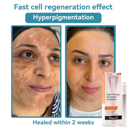 💞All-in-One CO₂ Laser Eraser Pen | Removes Moles, Warts, Skin Flaws & Pigmentation