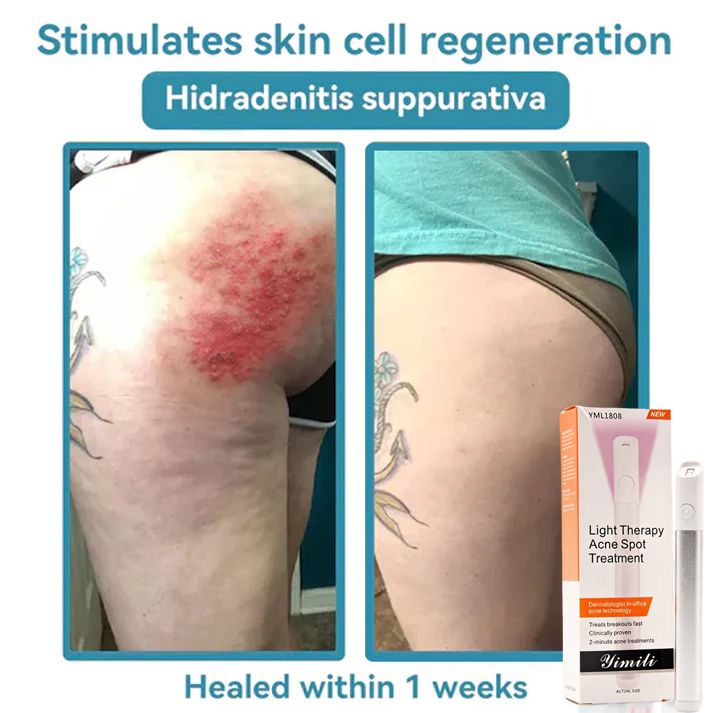 💞All-in-One CO₂ Laser Eraser Pen | Removes Moles, Warts, Skin Flaws & Pigmentation