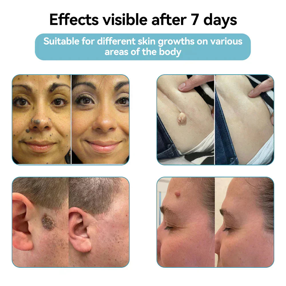 💞All-in-One CO₂ Laser Eraser Pen | Removes Moles, Warts, Skin Flaws & Pigmentation