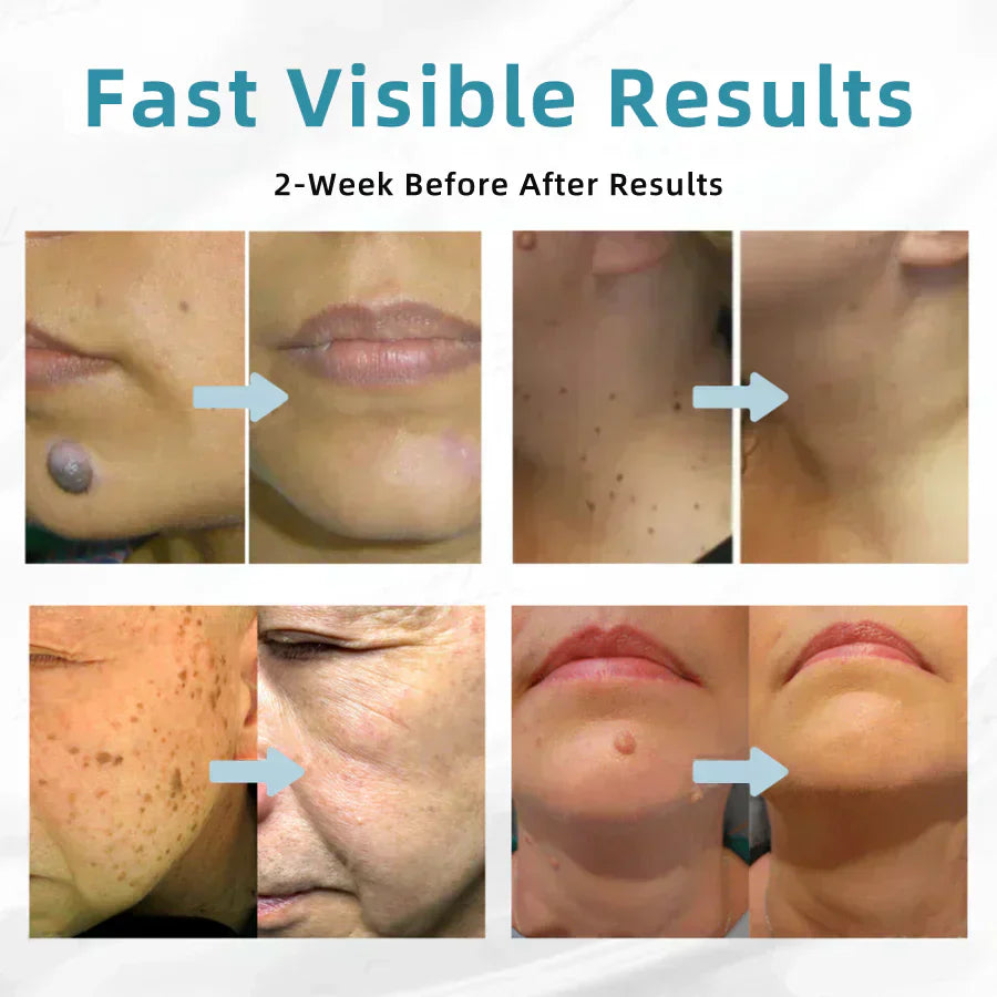 💞All-in-One CO₂ Laser Eraser Pen | Removes Moles, Warts, Skin Flaws & Pigmentation