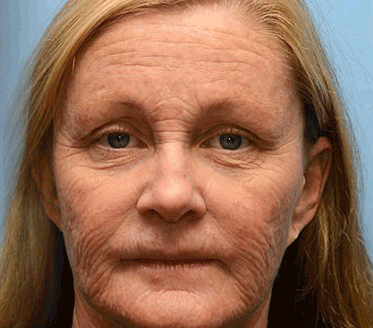 Final 3 Hours: 70%OFF🔥 QIAWI™ Botulinum & Vita-A Retinol Shot Wrinkle-Lift Tightening cream✨