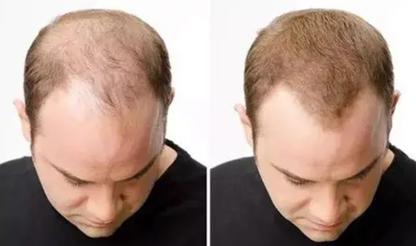 Hair Restoration Spray ( Reawaken Your Roots. Regrow Naturally. ✨ Clinically Proven Hair Regrowth Within 4 Weeks ✨)