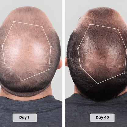 Torven Hair Regrowth Red Light Therapy