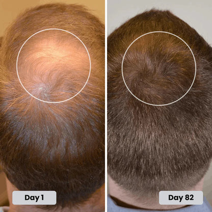 Torven Hair Regrowth Red Light Therapy